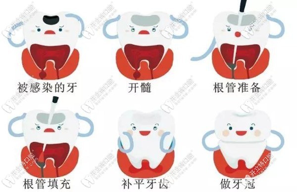 根管治療的流程圖