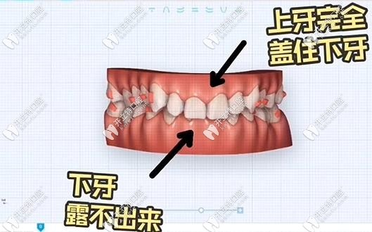 什么是闭锁性深覆合畸形牙齿
