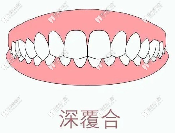 闭锁性深覆合怎么矫正