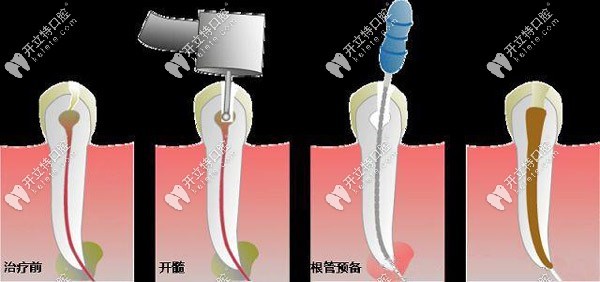 根管系統(tǒng)解剖因素也是失敗因素之一