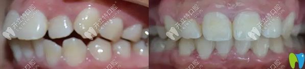 齙牙矯正代表案例