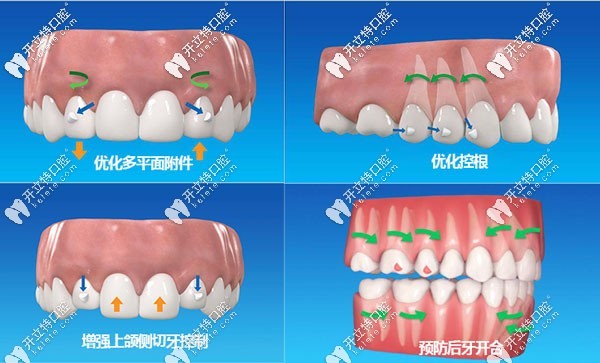 數(shù)字化口腔正畸口掃的效果展示
