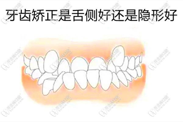 牙齒矯正是舌側(cè)好還是隱形好