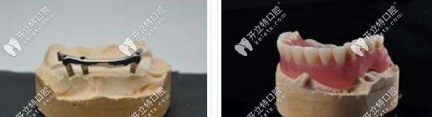 杆卡覆盖义齿修复