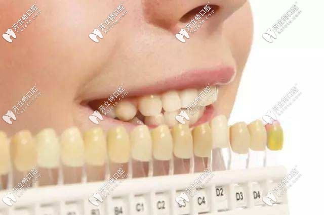 牙齒貼面色調(diào)對比 牙齒貼面色調(diào)對比