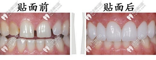 牙齒貼面前后對比圖