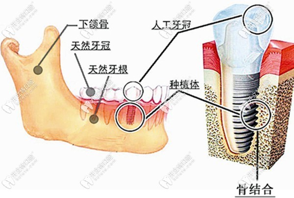 种植牙的结构图