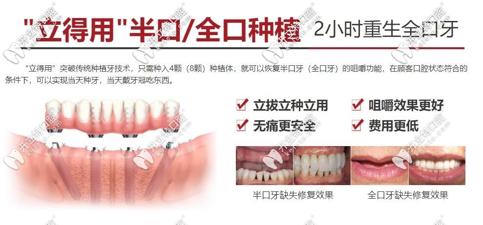 北京中诺口腔立得用种植牙介绍