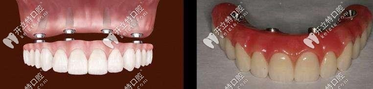 全口种植覆盖义齿