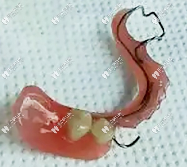 活動(dòng)式間隙保持器