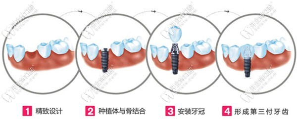 德国骨速生种植牙技术优势