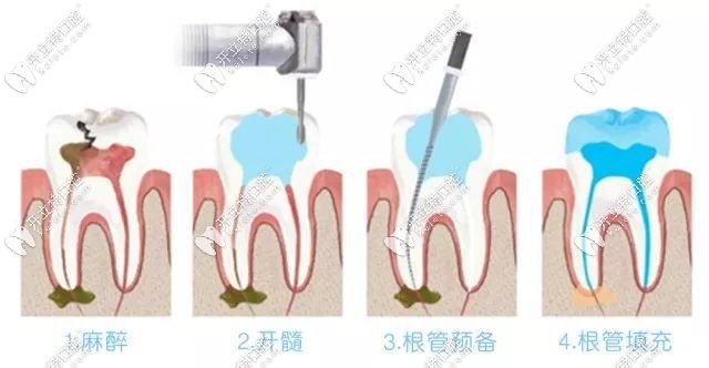 根管治療三次哪次比較疼kelete.com