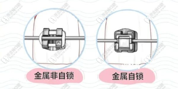 門牙牙縫大矯正