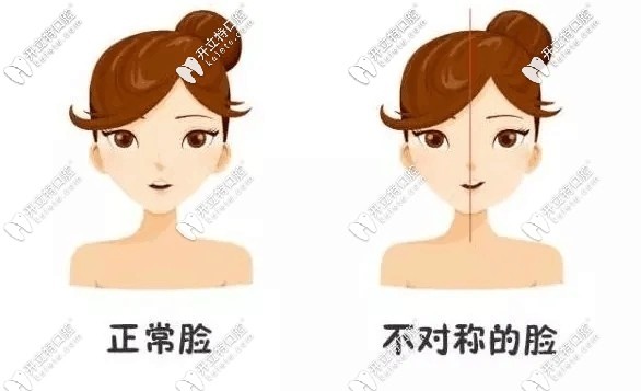 單側(cè)咀嚼會導(dǎo)致大小臉