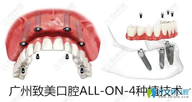 <!--<i data=20240703-sp></i>-->口腔allon4半口种植技术