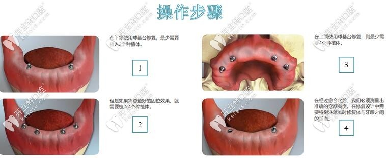 球帽式半固定種植牙步驟