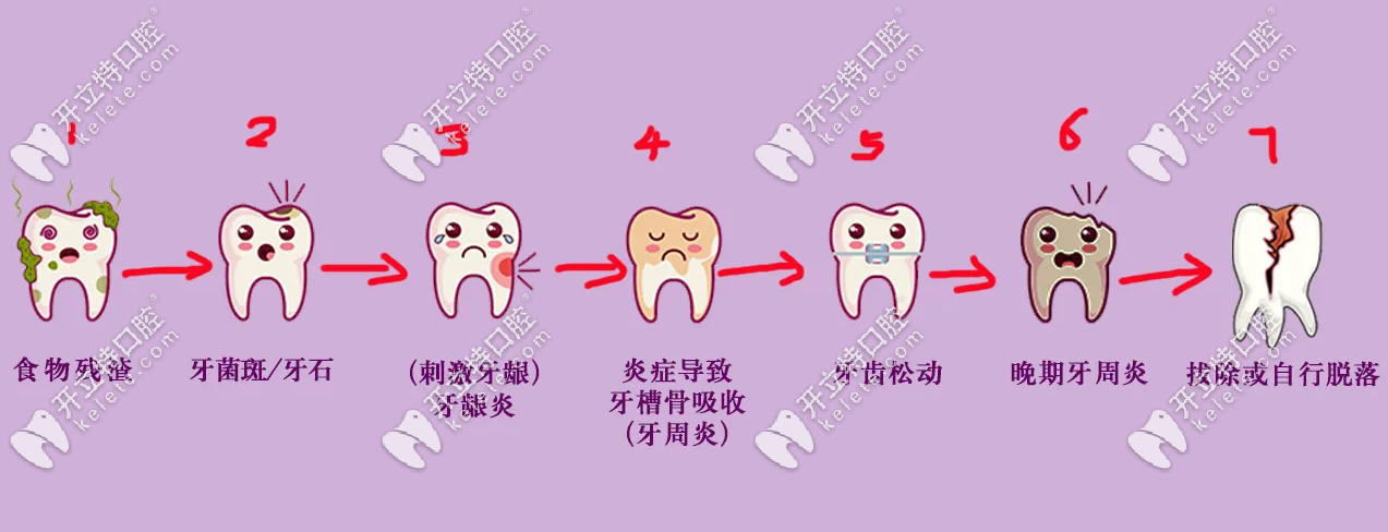 長(zhǎng)期不洗牙牙齒的變化過程
