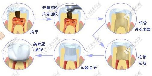 根管治療的具體步驟