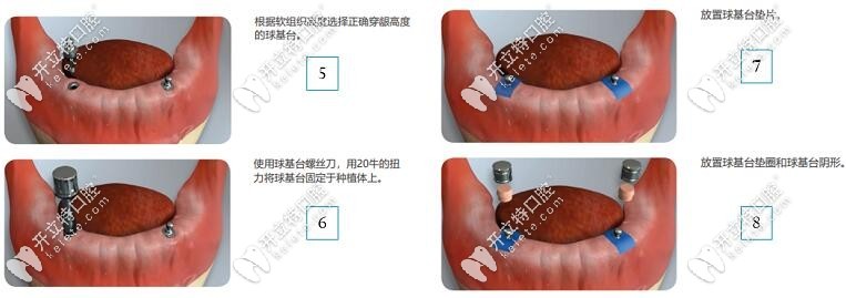 球帽式覆蓋義齒流程