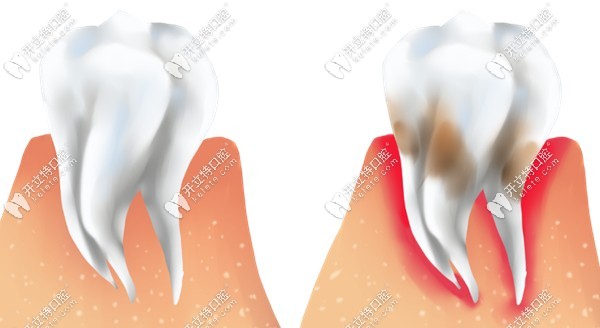 健康牙齦與發(fā)炎牙齦對(duì)比