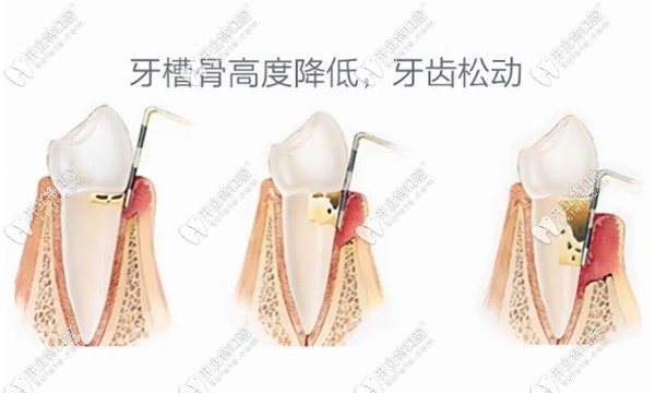 牙槽骨吸收的診斷標準