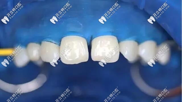 牙科橡皮障