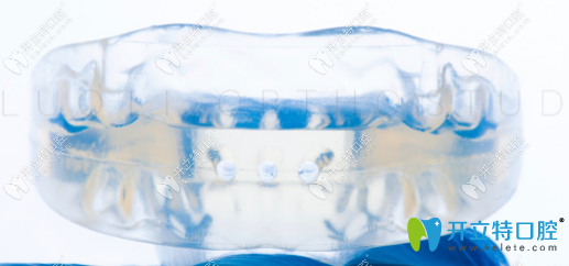兒童羅慕咬合誘導(dǎo)矯治器