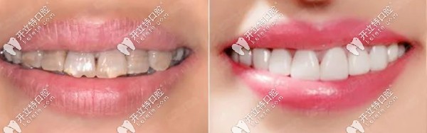 美加全瓷牙冠美牙前后對(duì)比