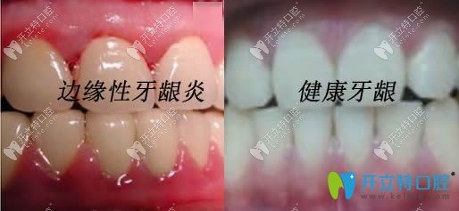 開(kāi)立特邊緣性牙齦炎和正常牙齦對(duì)比圖