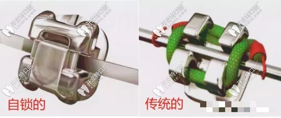 自鎖托槽和傳統(tǒng)托槽區(qū)別