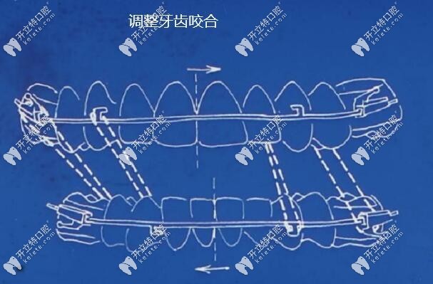 調(diào)整牙齒咬合關系