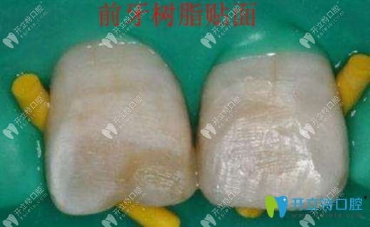 樹脂貼面修復(fù)牙體缺損效果圖