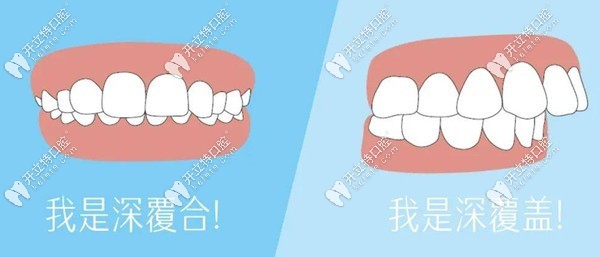 深覆合與深覆蓋的區(qū)別