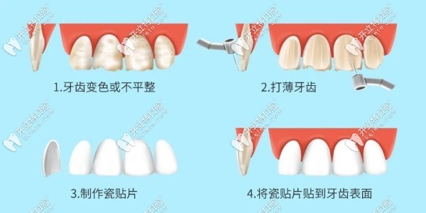 鑄瓷貼面和全瓷貼面的制作過程