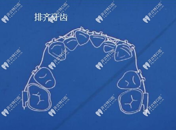 方絲弓牙齒矯正步驟