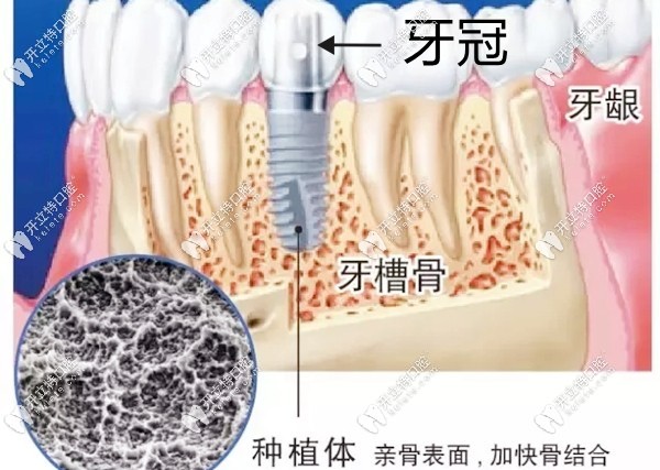 種植體和牙冠在牙槽骨內(nèi)的圖