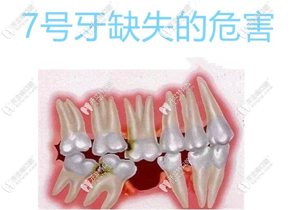 7號牙缺失的危害