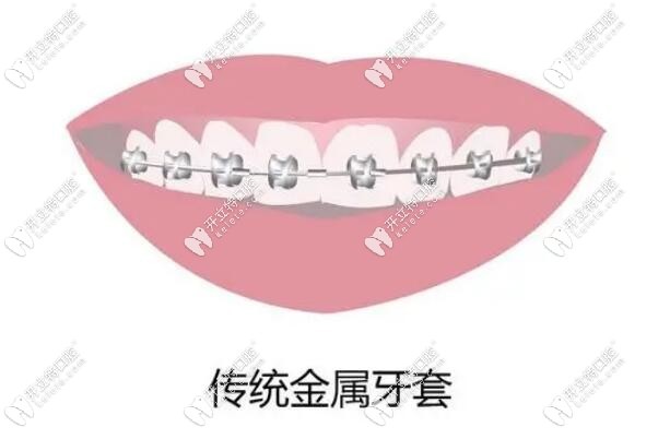 鋼絲牙套矯正速度更快