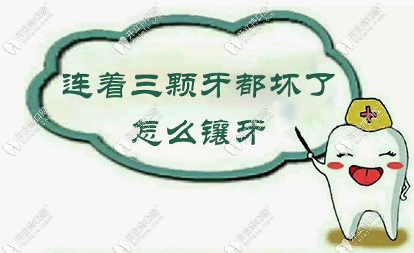 連著三顆牙都?jí)牧嗽趺磋傃? border=