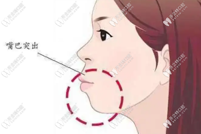 正常上牙比下牙突幾毫米