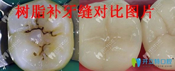 樹脂補牙縫對比圖片