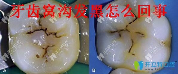 牙齒窩溝發(fā)黑怎么回事