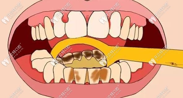 牙结石示意图www.kelete.com