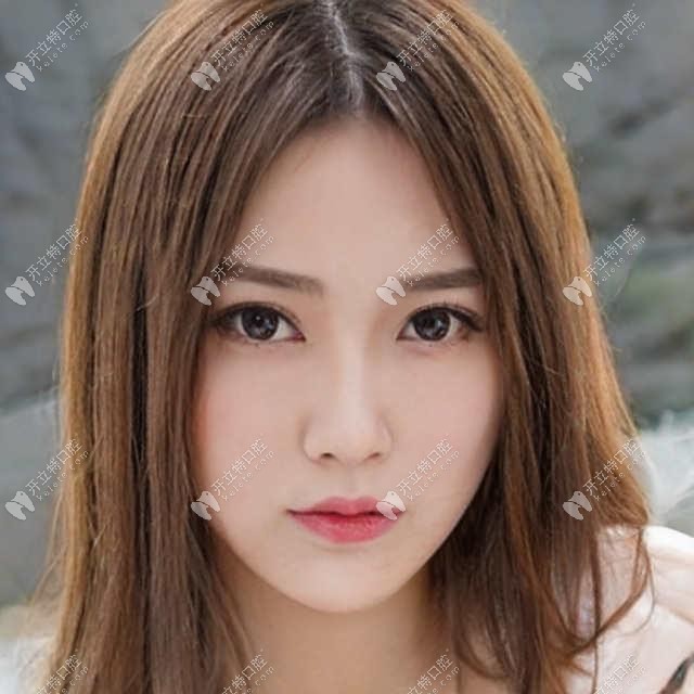 德国ICX穿颧种植体超大角度的复合基台面世啦