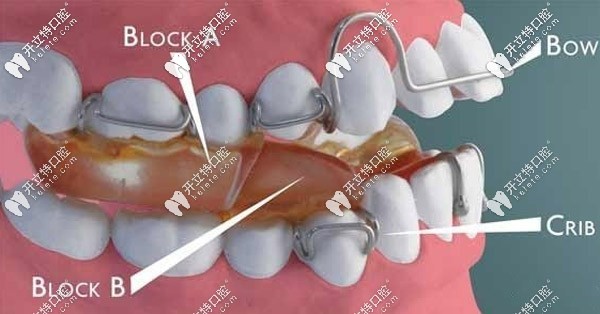 什么是Twin-Block雙頜墊矯治器？