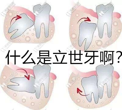 什么是立世牙啊