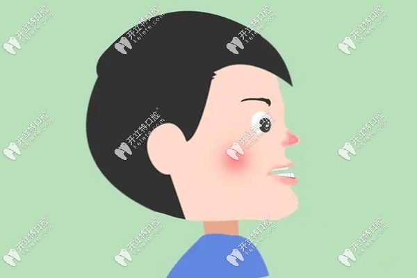 兒童反頜正畸注意哪些方面