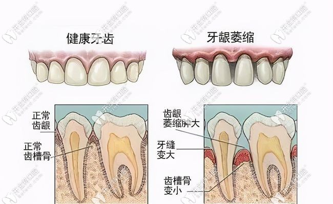 牙槽骨萎缩示意图