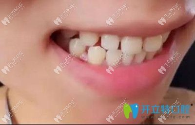 牙齒稀疏怎么治療好呢