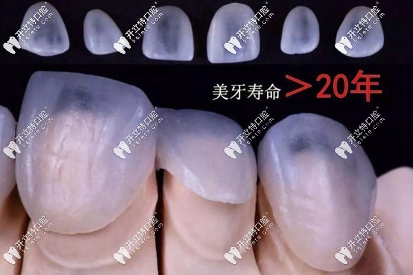 全口16顆超薄瓷貼面的價格
